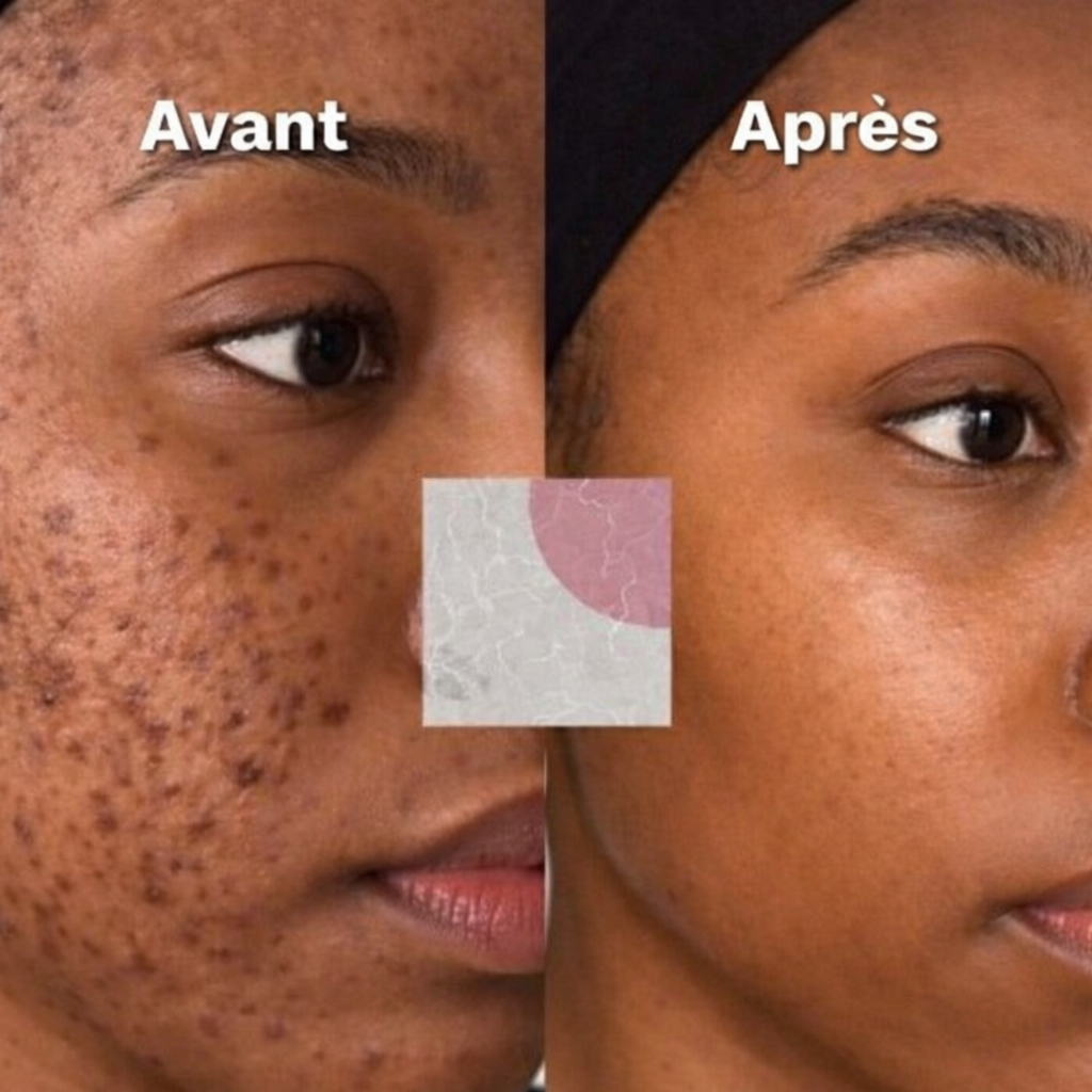 Savon Anti-Taches & Hyperpigmentation au curcuma